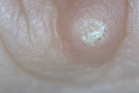Know About Warts signs and Therapies with Prevention Suggestions